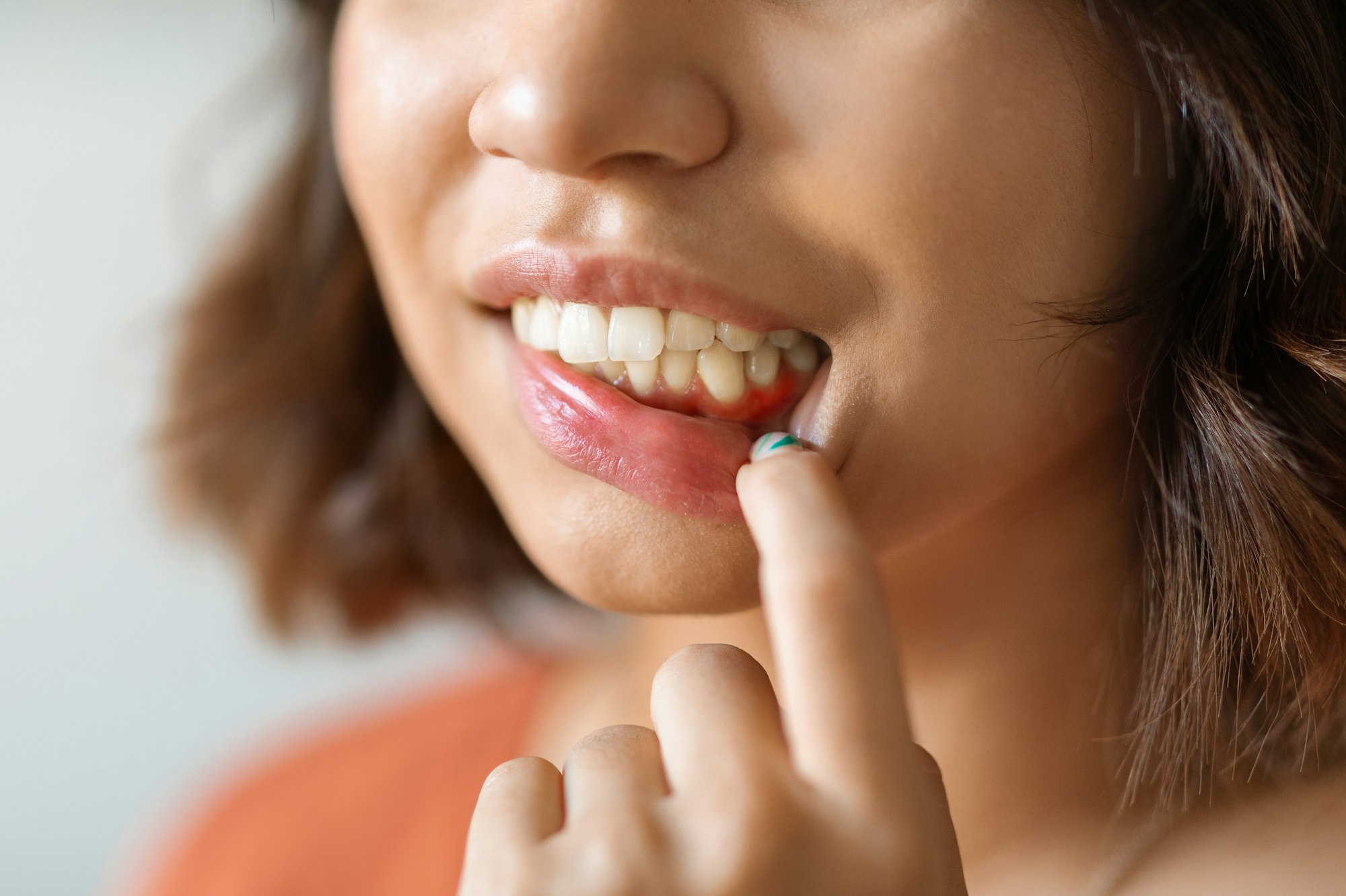 Young woman pulling her bottom lip down to show irritated gums, indicating early signs of Gingivitis addressed at Schlueter Periodontics.